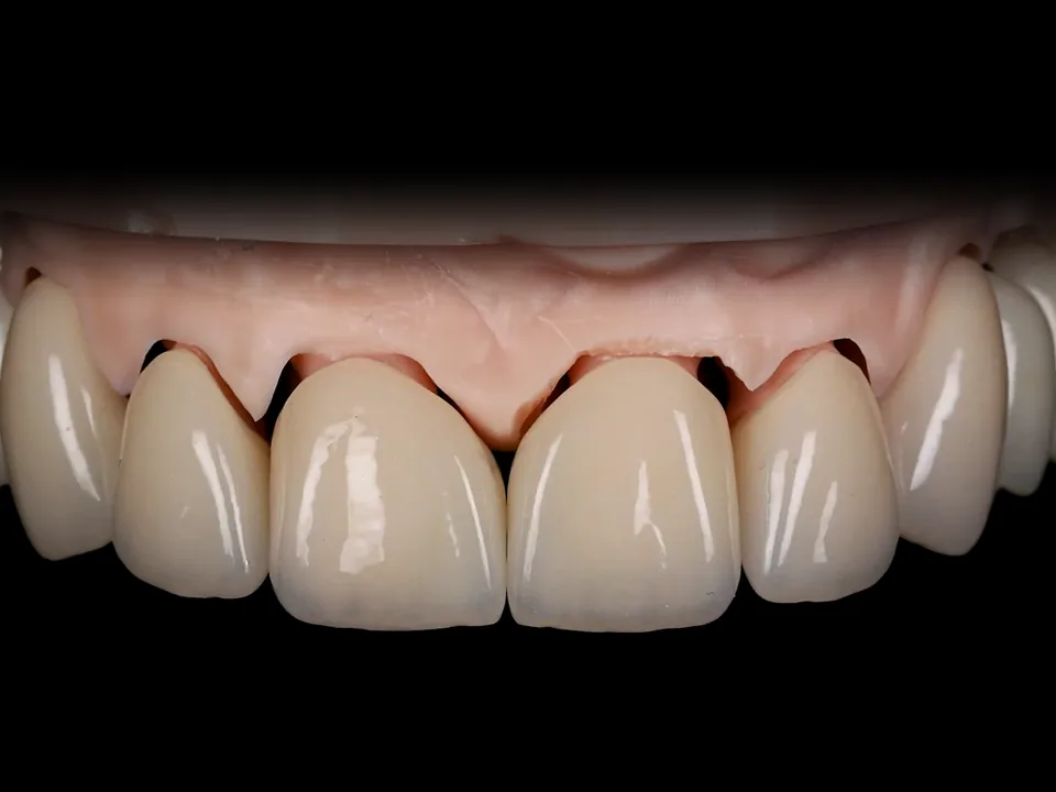 Zirconia on implants and teeth, Bleach 4