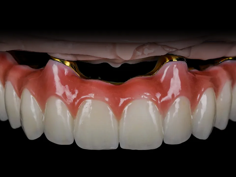 All-on-4: veneered zirconia on a titanium bar