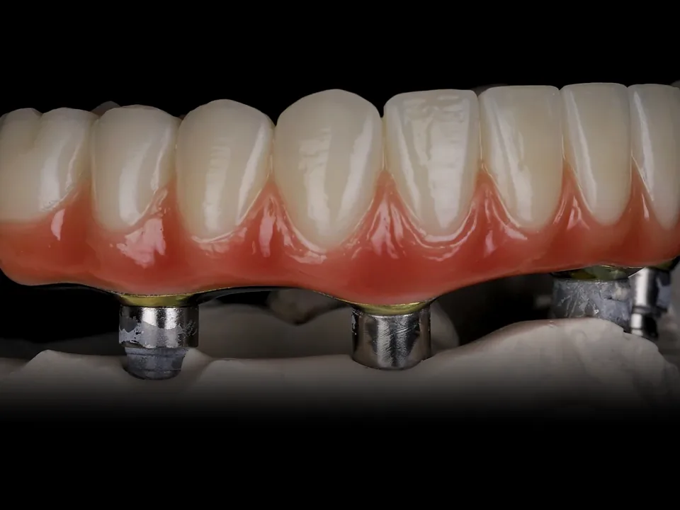 FP1 / FP2: zirconia on titanium bars