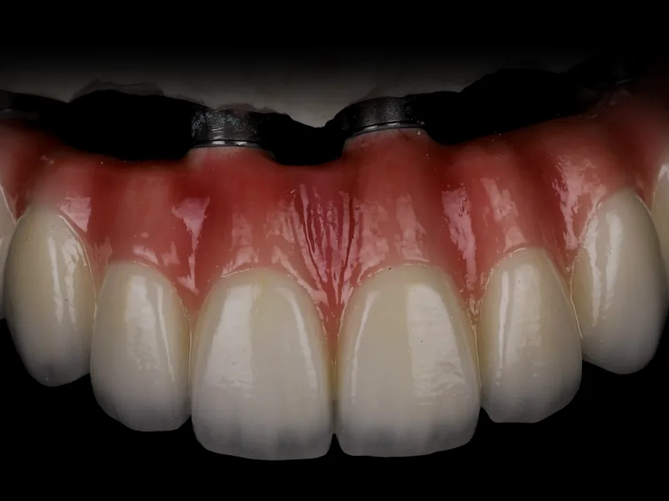 Metal-ceramic on 6 implants