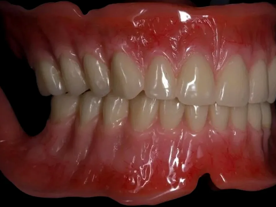 Complete dentures, side view