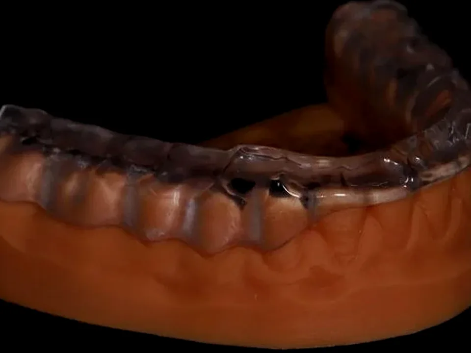 Full-arch splint