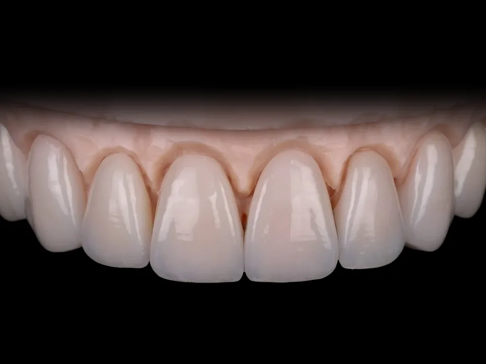 IPS e.max Press LT veneers, Bleach 3