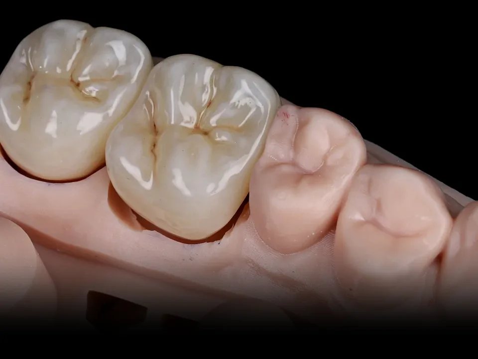 Single restorations: crowns, overlay, inlay/onlay
